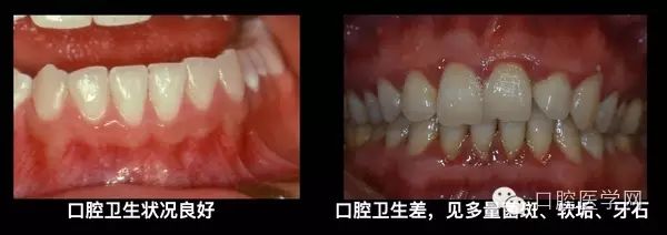 洗牙、使用牙線會把牙縫弄大嗎？牙縫爲何會越來越大？