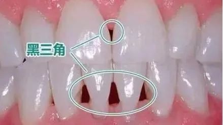 牙齒上難看的“黑三角”到底是怎麼來的？