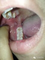 長期自然咬頰的病因分析與修復治療