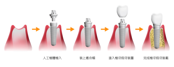 澳門種牙攻略：點樣揀啱嘅植體品牌同方案